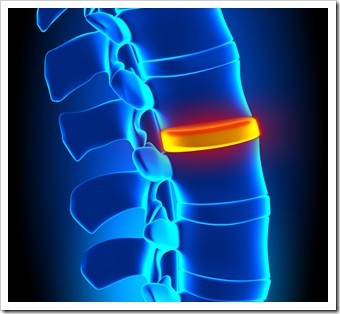 Herniated Disc and Back Pain Fort Mill SC