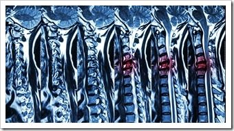 Back Pain Rehab Fort Mill SC Spinal Surgery